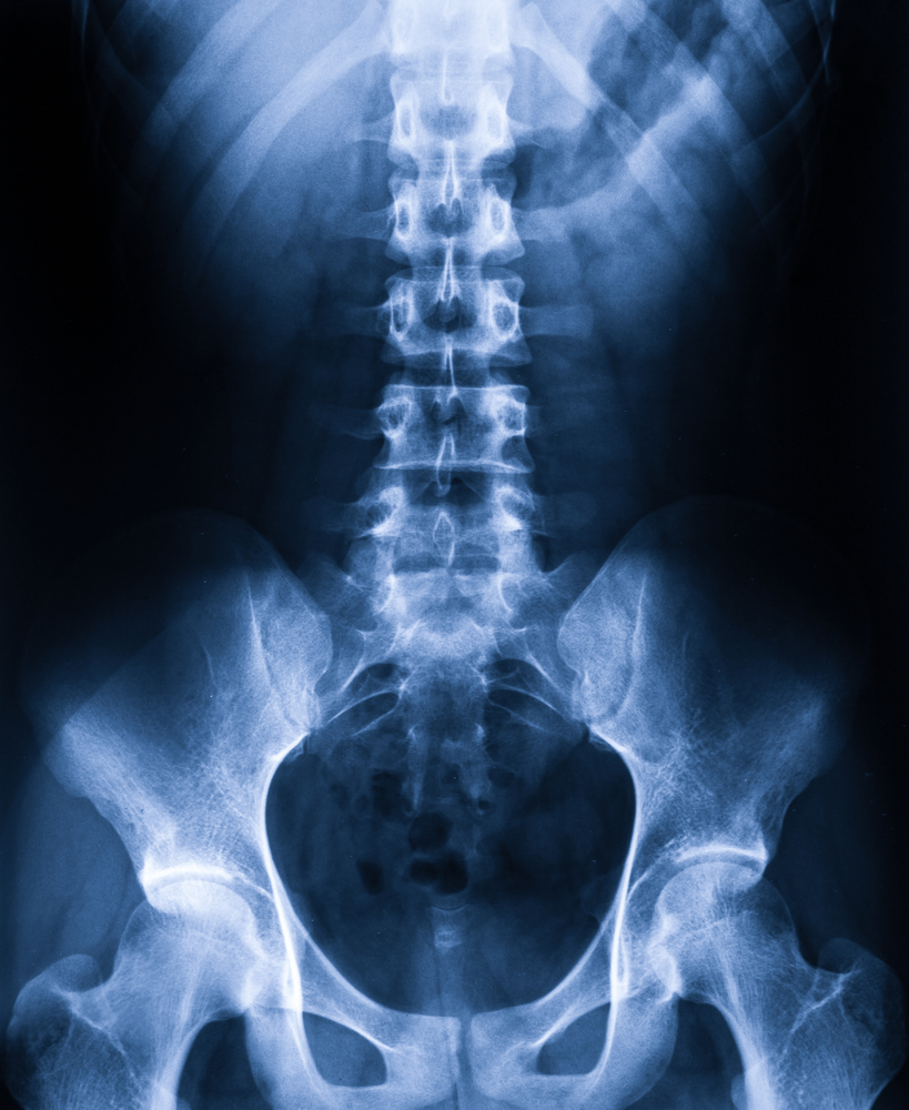 Living with Spinal Stenosis - Colorado Pain Care