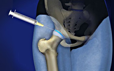 hip joint injections pain management denver co