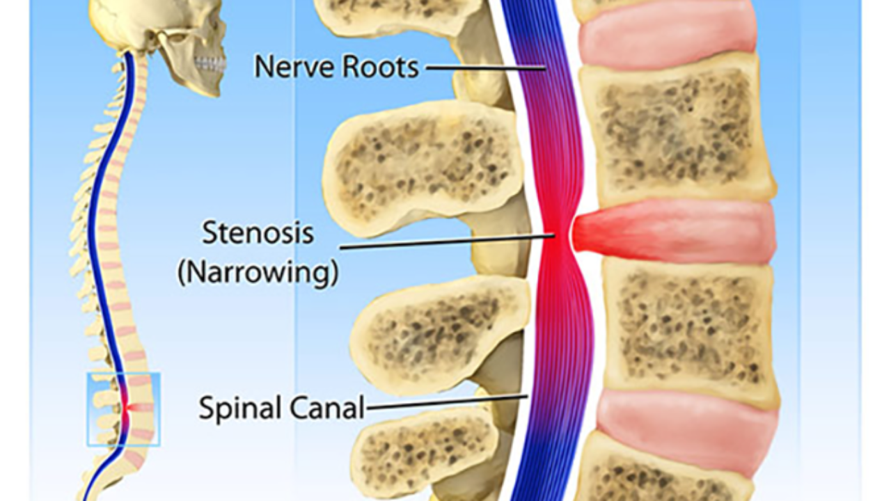 narrowing of the spine