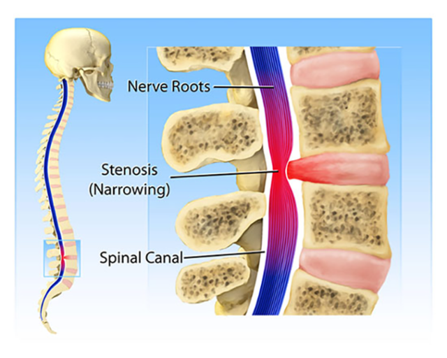 What you need to know about spinal stenosis - Colorado Pain Care