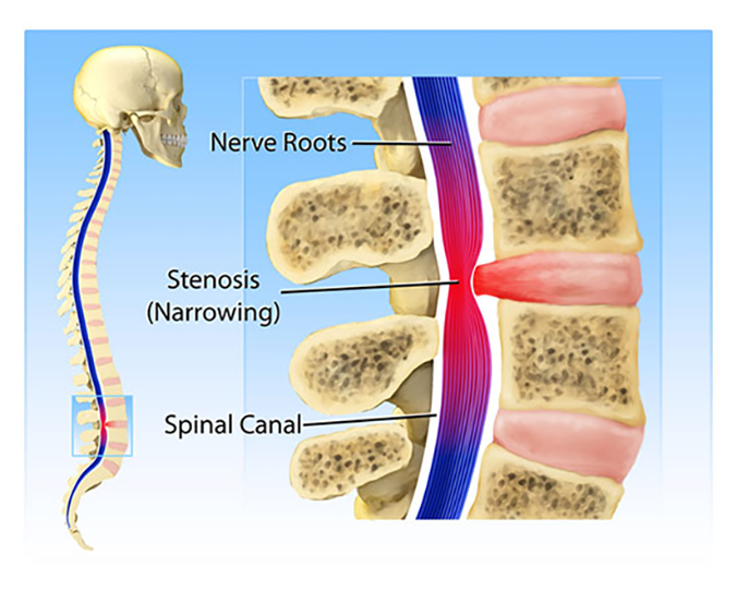 Spinal Stenosis causes, symptoms and treatment - Truspine