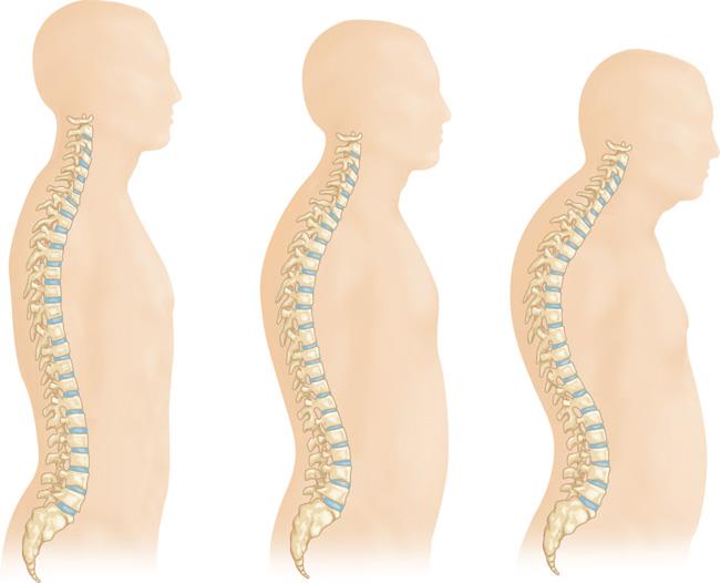 Nutrtion and osteoporosis - Colorado Pain Care