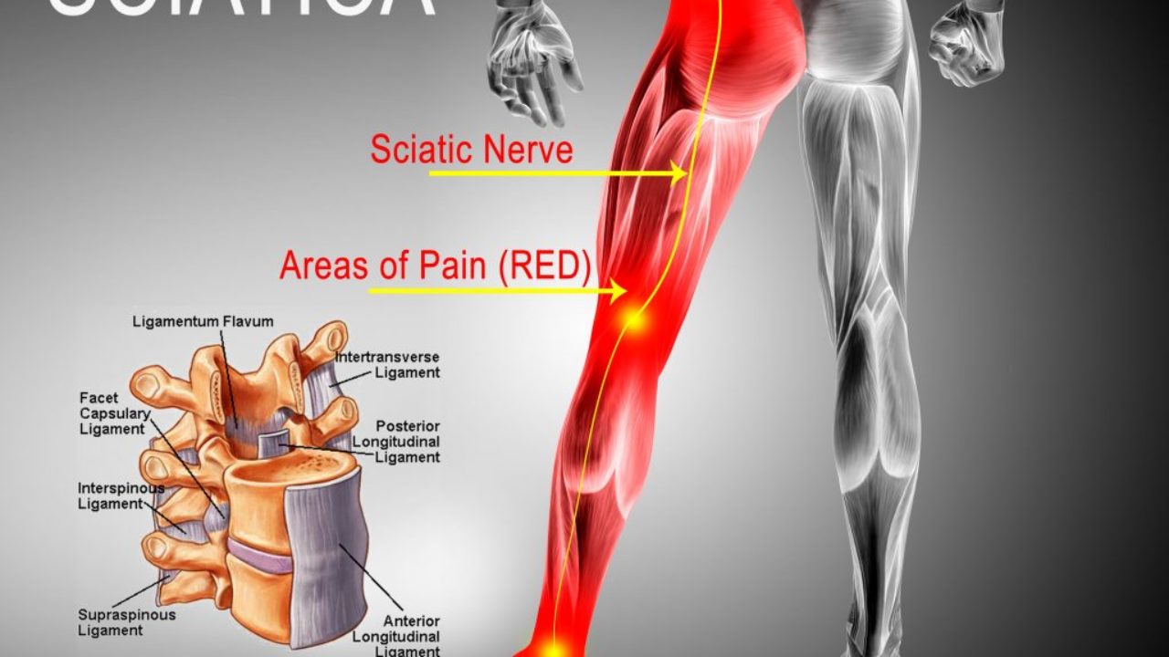 Banish Sciatica Pain with Physical Therapy Center