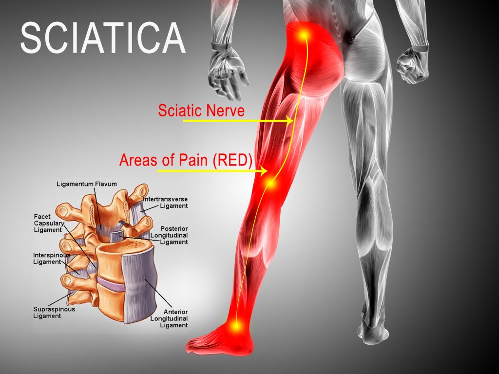sciatica pain colorado pain care blog