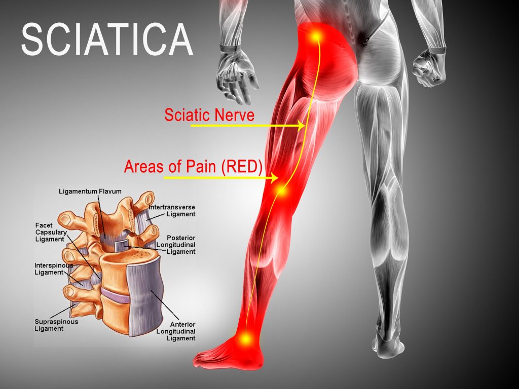 Chronic Back Pains Cervical Spondylosis Disc Herniation Stenosis 
