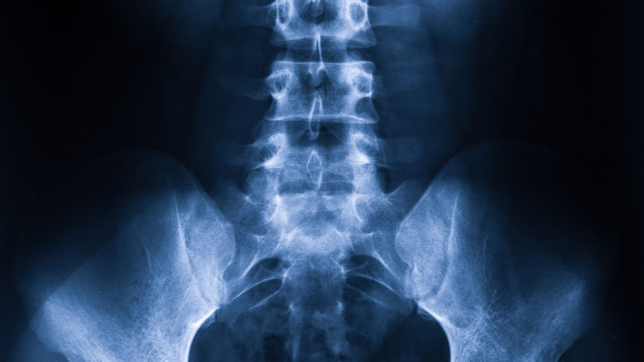 Spinal Stenosis in Long Island, NY