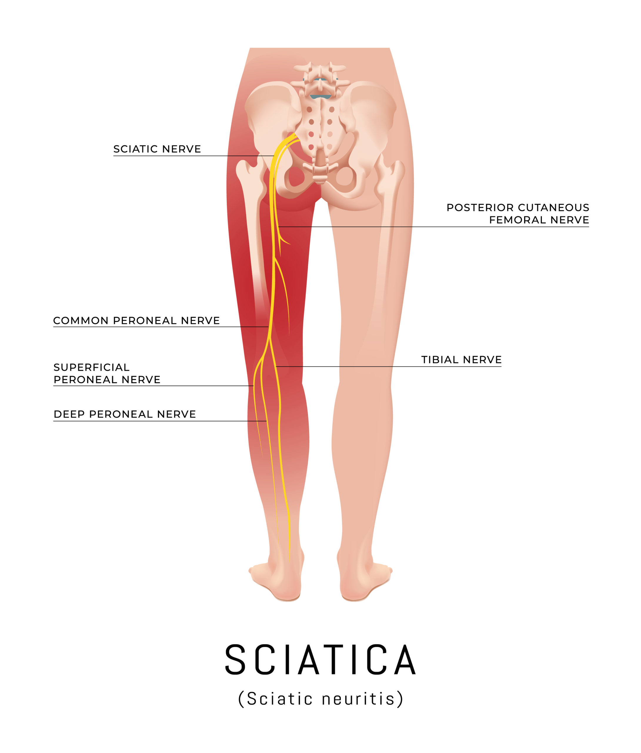 Sciatica: What It Is, Causes, Symptoms, Treatment & Pain Relief