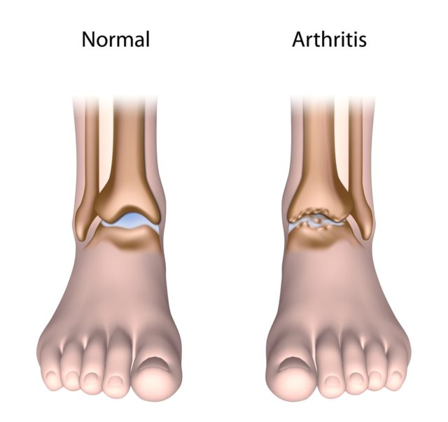 Ankle Osteoarthritis - Colorado Pain Care