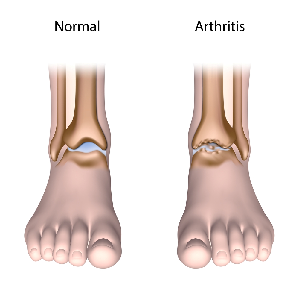 Juvenilis arthritis psoriatica