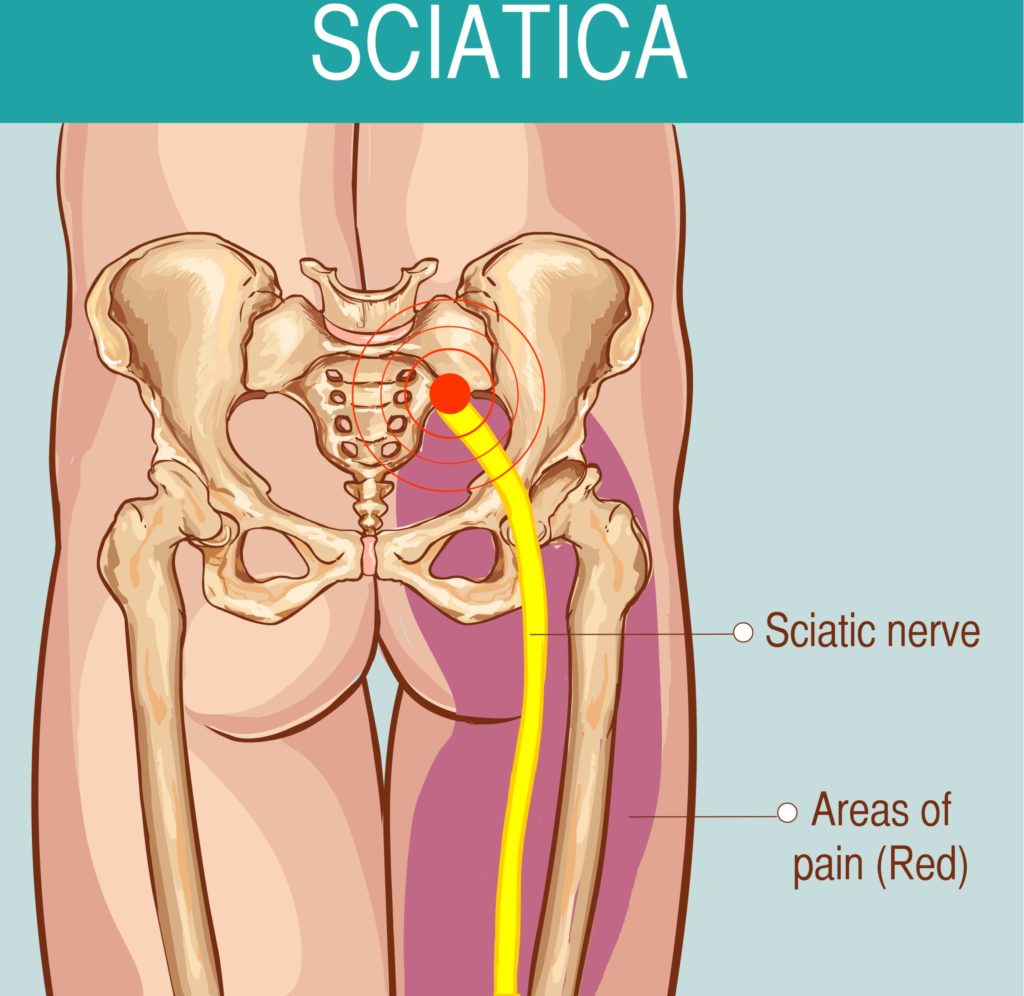 New Sciatica Blog Image Colorado Pain Care new-sciatica-blog-image-colorado-pain-care