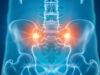 Posterior Sacroiliac Fusion Procedures
