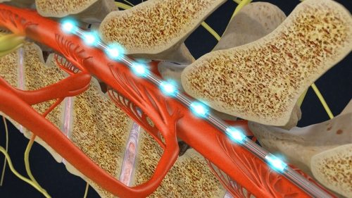 spinal cord stimulation pain management denver co