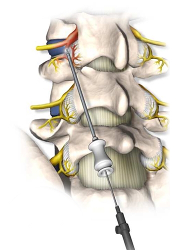 cervical facet radiofrequency neurotomy pain specialists denver co
