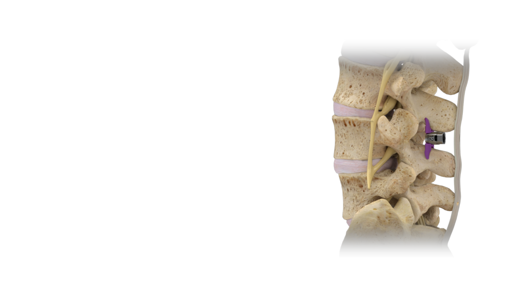 superion interspinous spacer pain management Denver CO