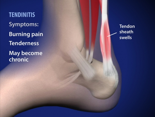 achilles tendonitis pain specialists denver co