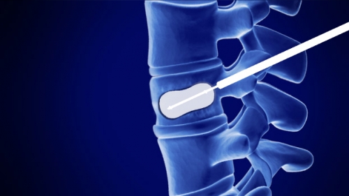 vertebroplasty & kyphoplasty pain physicians denver co