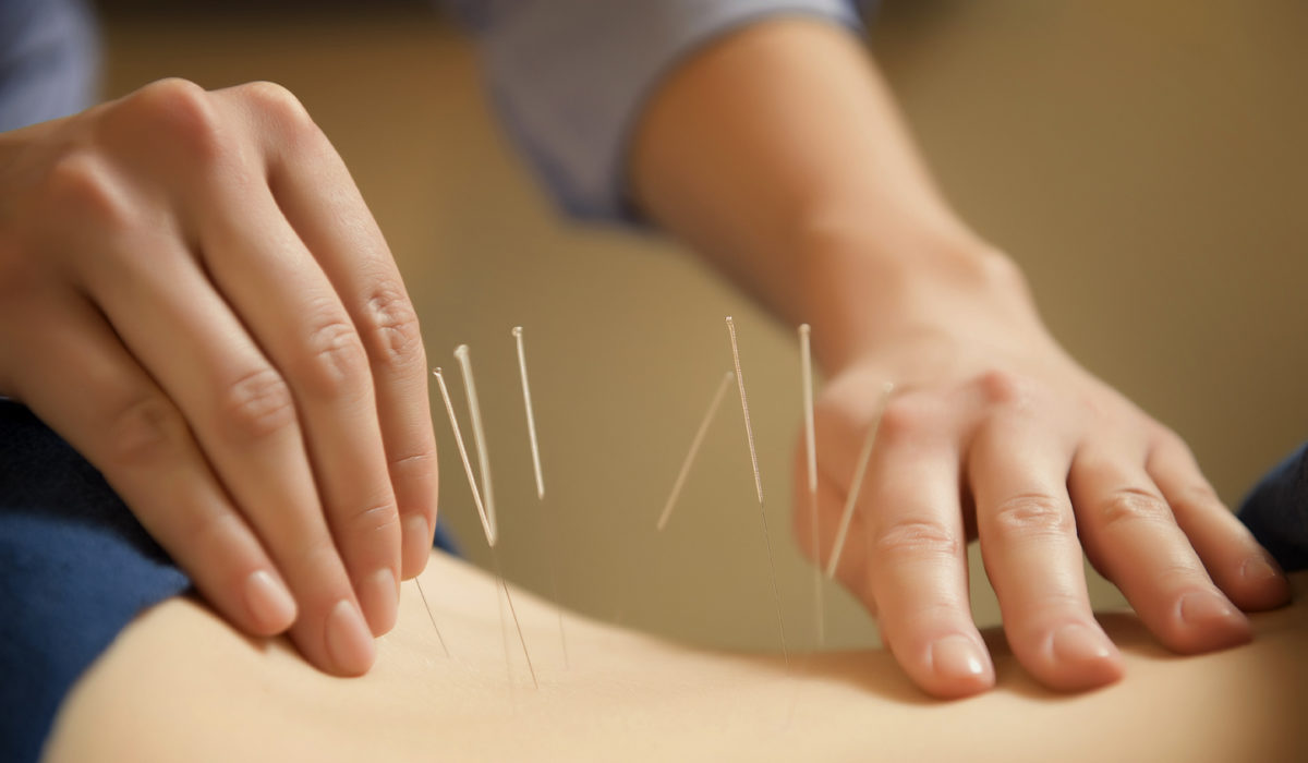 FDA proposes doctors learn about acupuncture for pain management