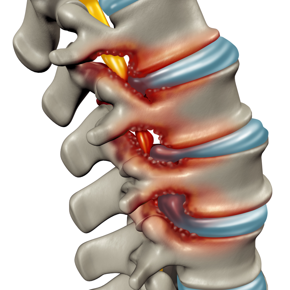 Spinal Stenosis Meaning In Chinese